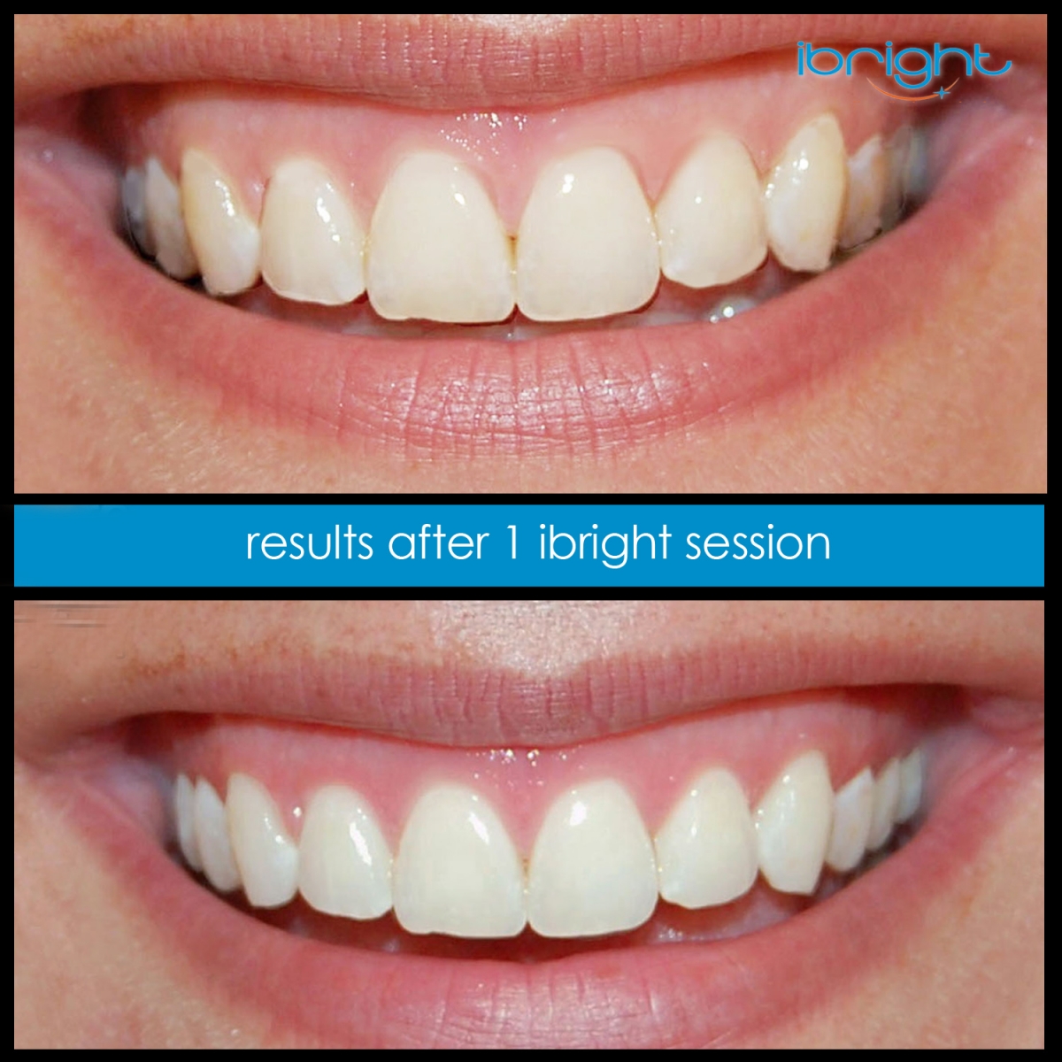 ibright smartphonewhitening beforeandafter1