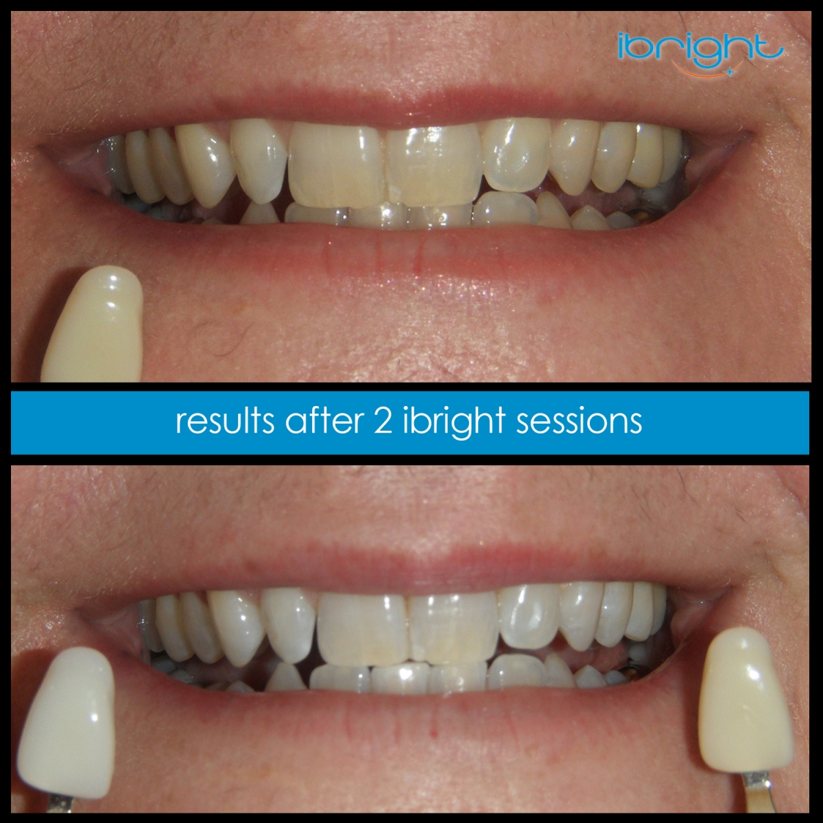 ibright smartphonewhitening beforeandafter2 2