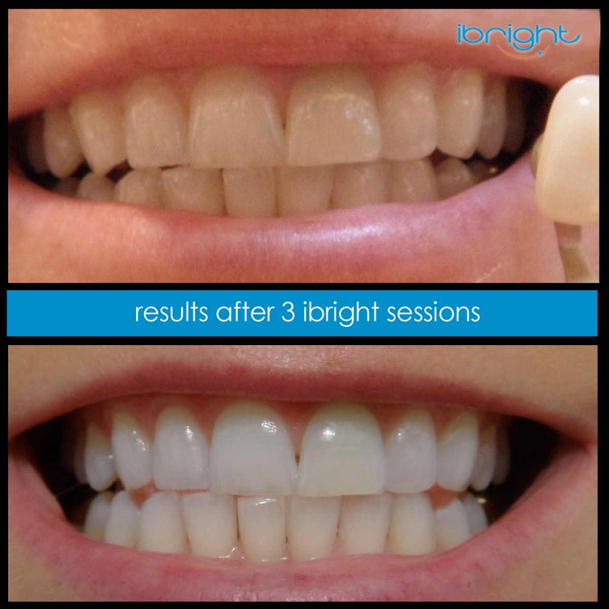 ibright smartphonewhitening beforeandafter2 3