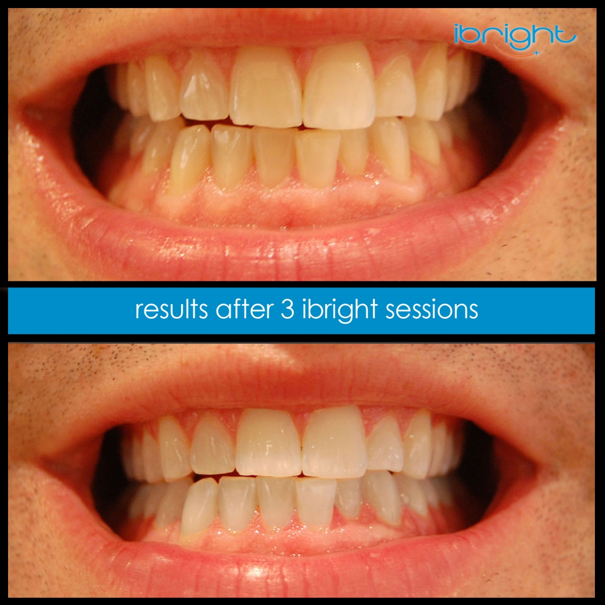 ibright smartphonewhitening beforeandafter3