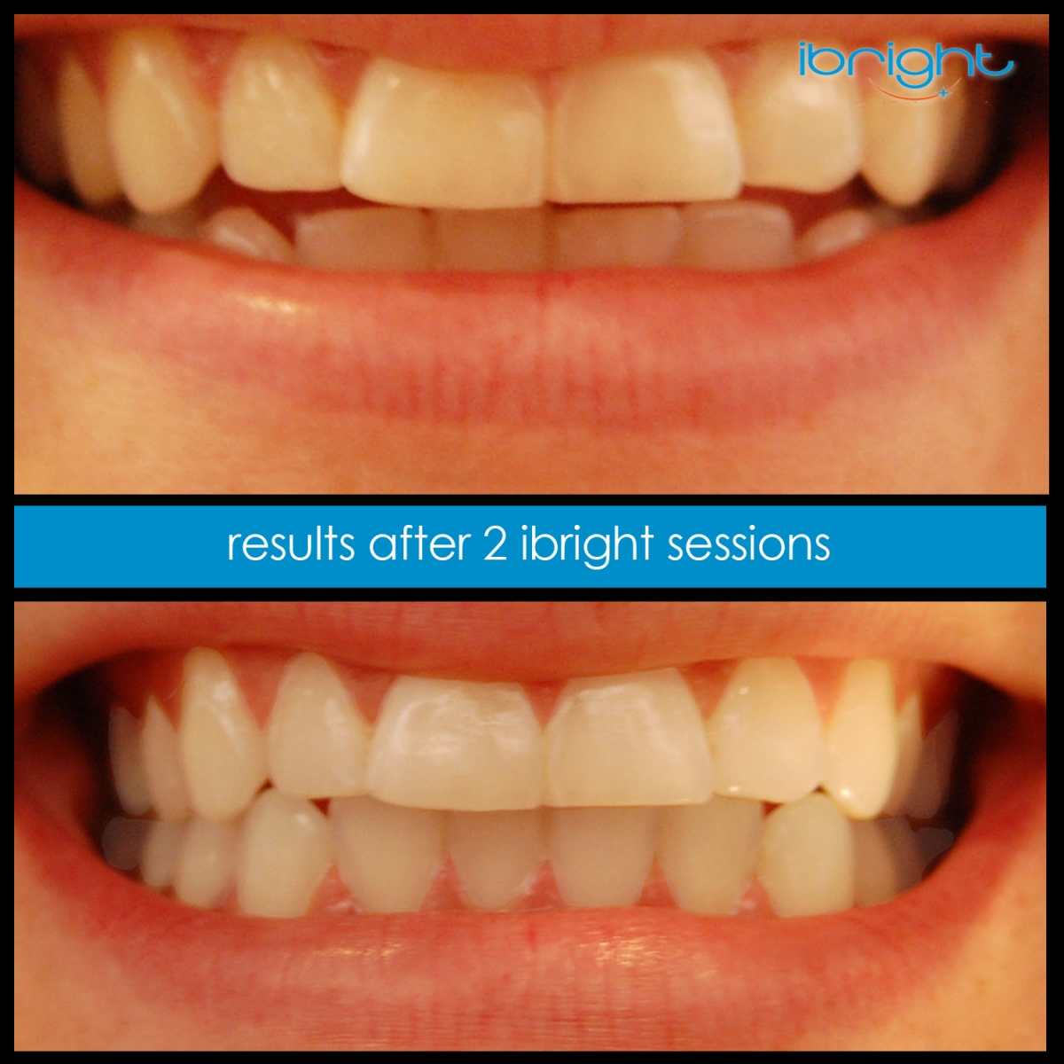 ibright smartphonewhitening beforeandafter3 2