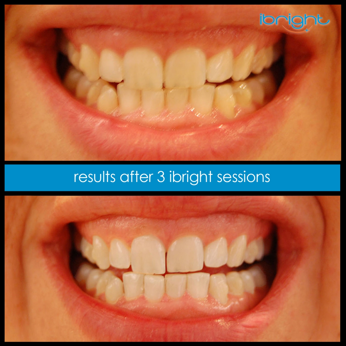 ibright smartphonewhitening beforeandafter3 3